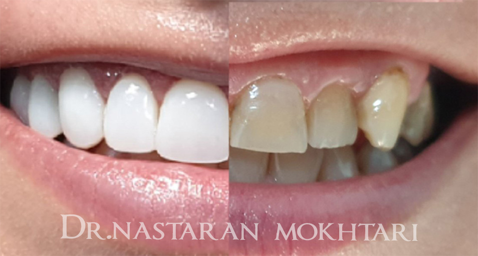 دکتر نسترن مختاری - متخصص ترميمی و زیبایی (کامپوزیت ونیر / لمینیت کامپوزیتی)